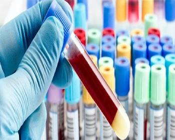Fda, Beyin Hasarını Belirleyen Kan Testine Onay Verdi